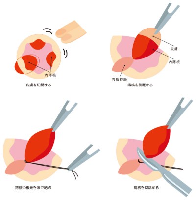 結紮切除術（根治術）