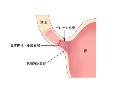バレット食道とは