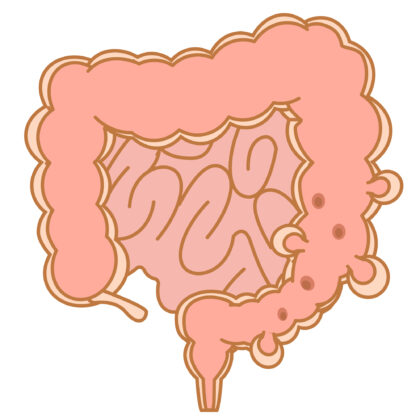 大腸憩室症とは
