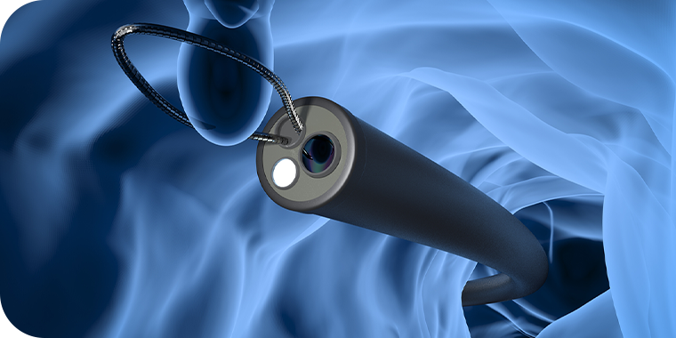 大腸ポリープ切除で大腸がんの予防